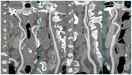 Photon-Counting Computed Tomography Angiography of Carotid Arteries: A ...