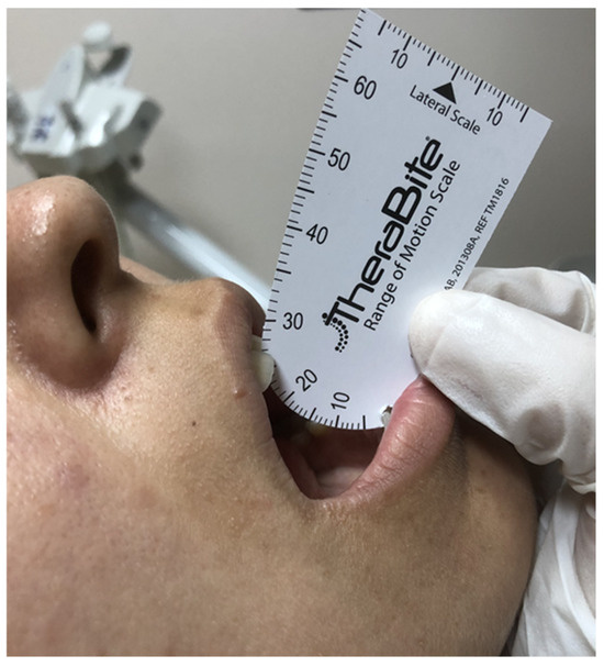 The Prediction of Radiation-Induced Trismus by the Apparent 