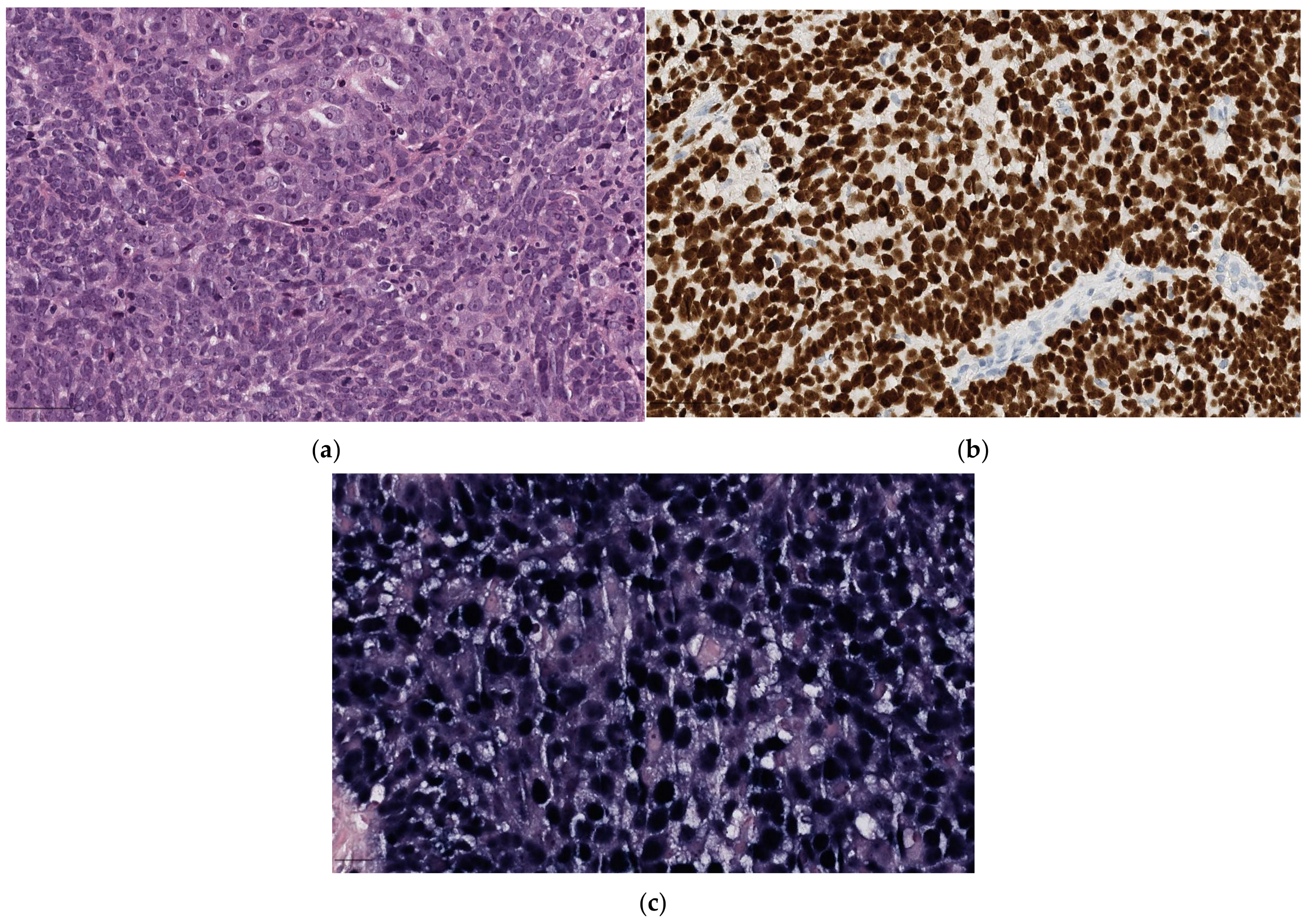 Rare Head and Neck Cancers and Pathological Diagnosis Rare Head and Neck Cancers and Pathological Diagnosis