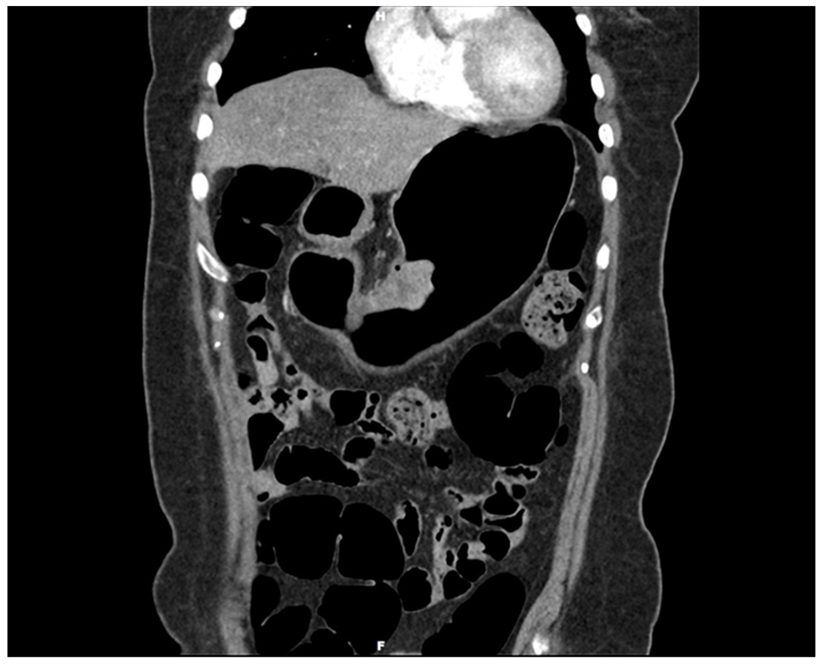 Tumors of the Pancreas (Afip Atlas of Tumor Pathology; 4th