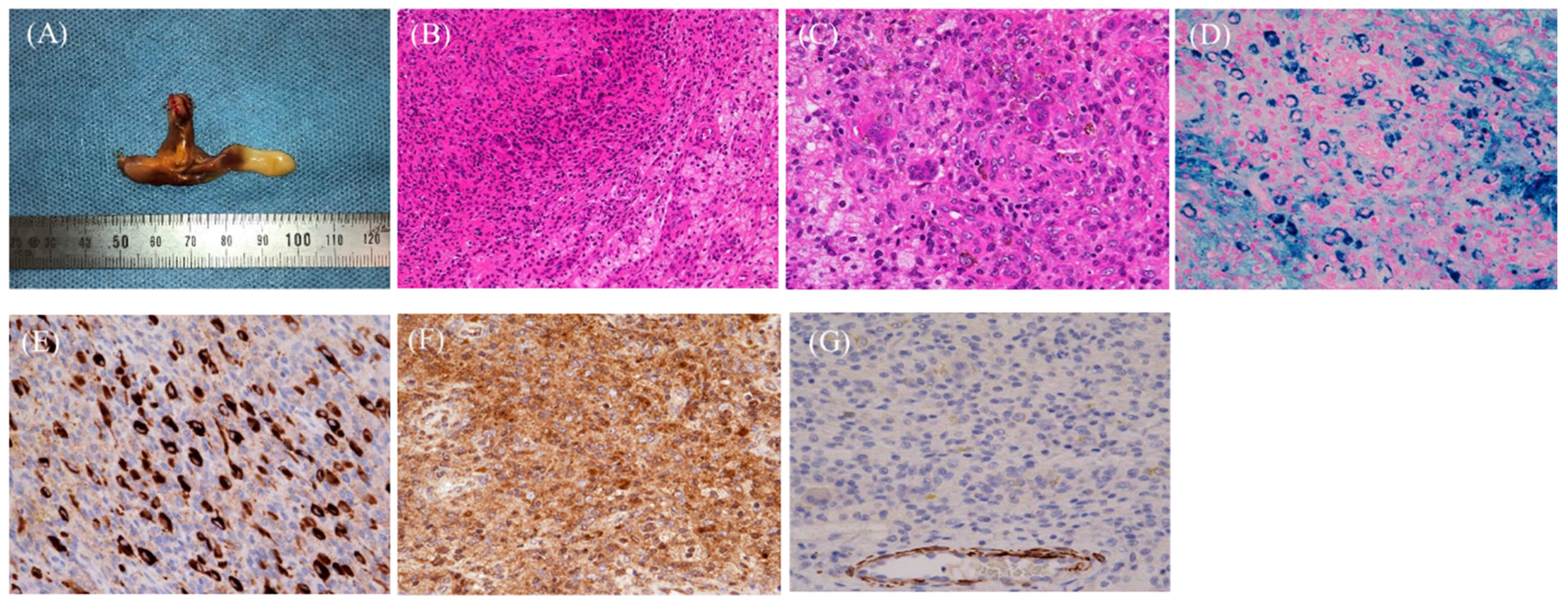 Tumor Multicentric Giant Cell Tumor of Bone | Orthopedics