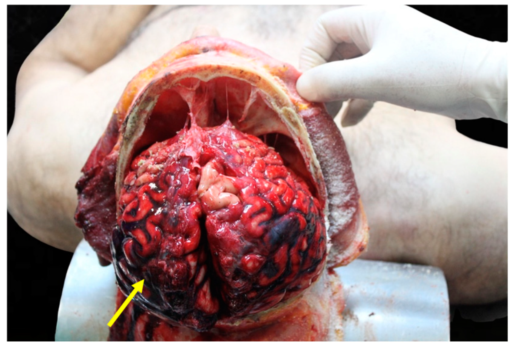 autupsy The Role of Autopsy in the Forensic and Clinical Evaluation of Head Trauma  and Traumatic Brain Injury in Road Traffic Accidents: A Review of the  Literature