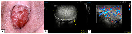 Transperineal Vulvar Ultrasound: A Review of Normal and Abnormal ...