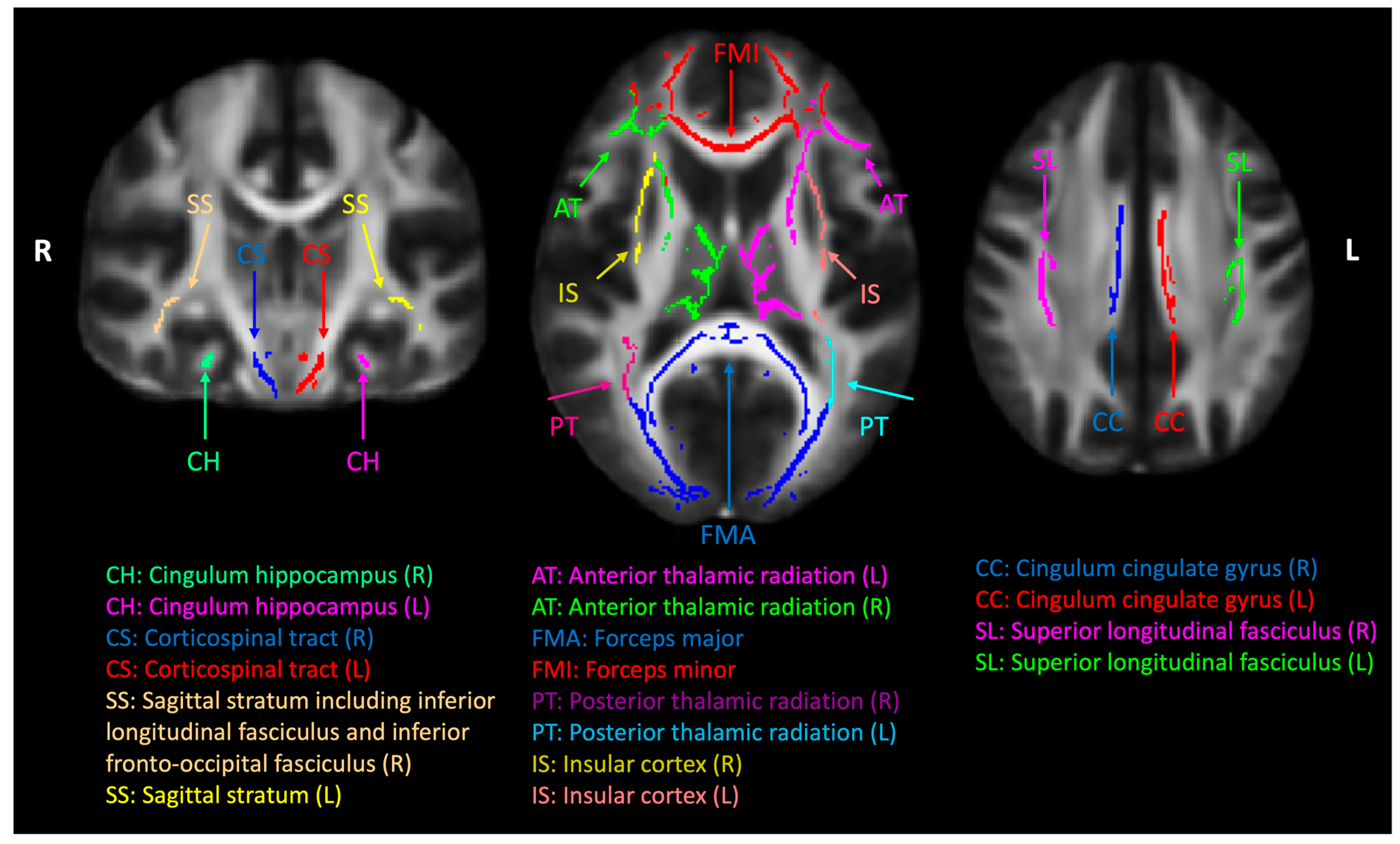 Pain-Related White-Matter Changes Following Mild Traumatic
