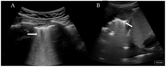 Lung Ultrasound in Critical Care: A Narrative Review