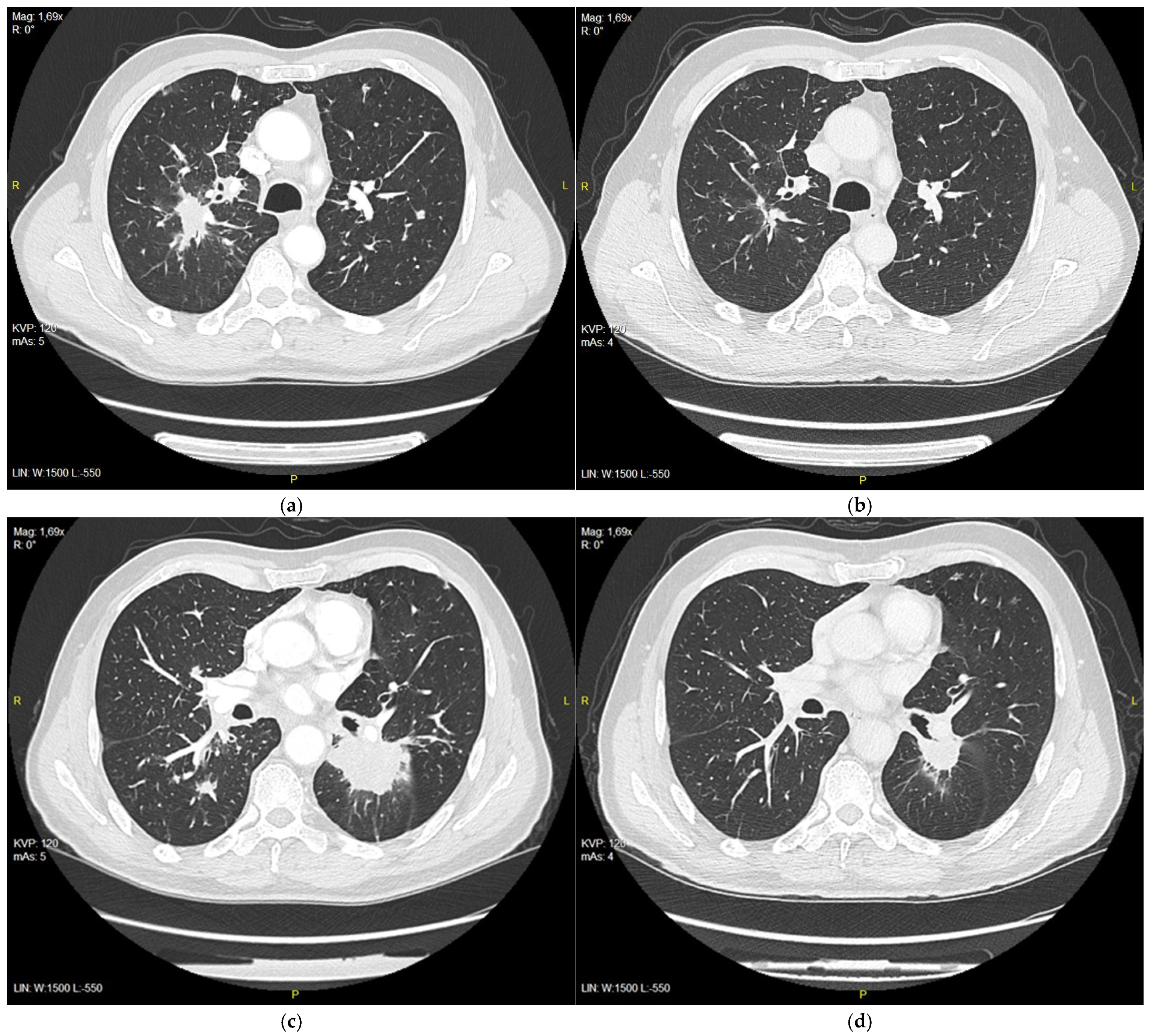 RT-PCR Misdiagnosis of Patient with Rare EGFR Mutation Lung