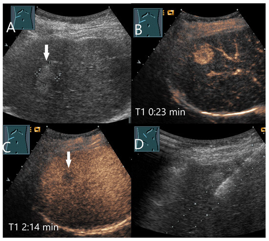 Washout on Contrast-Enhanced Ultrasound of Benign Focal