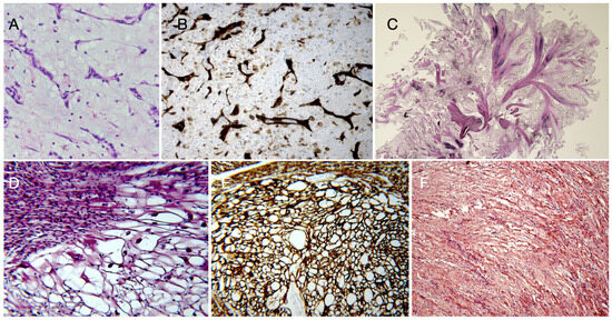 A Comprehensive Review of Cardiac Tumors: Imaging, Pathology