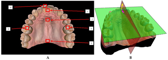 Three-Dimensional Semantic Segmentation of Palatal Rugae and Maxillary ...