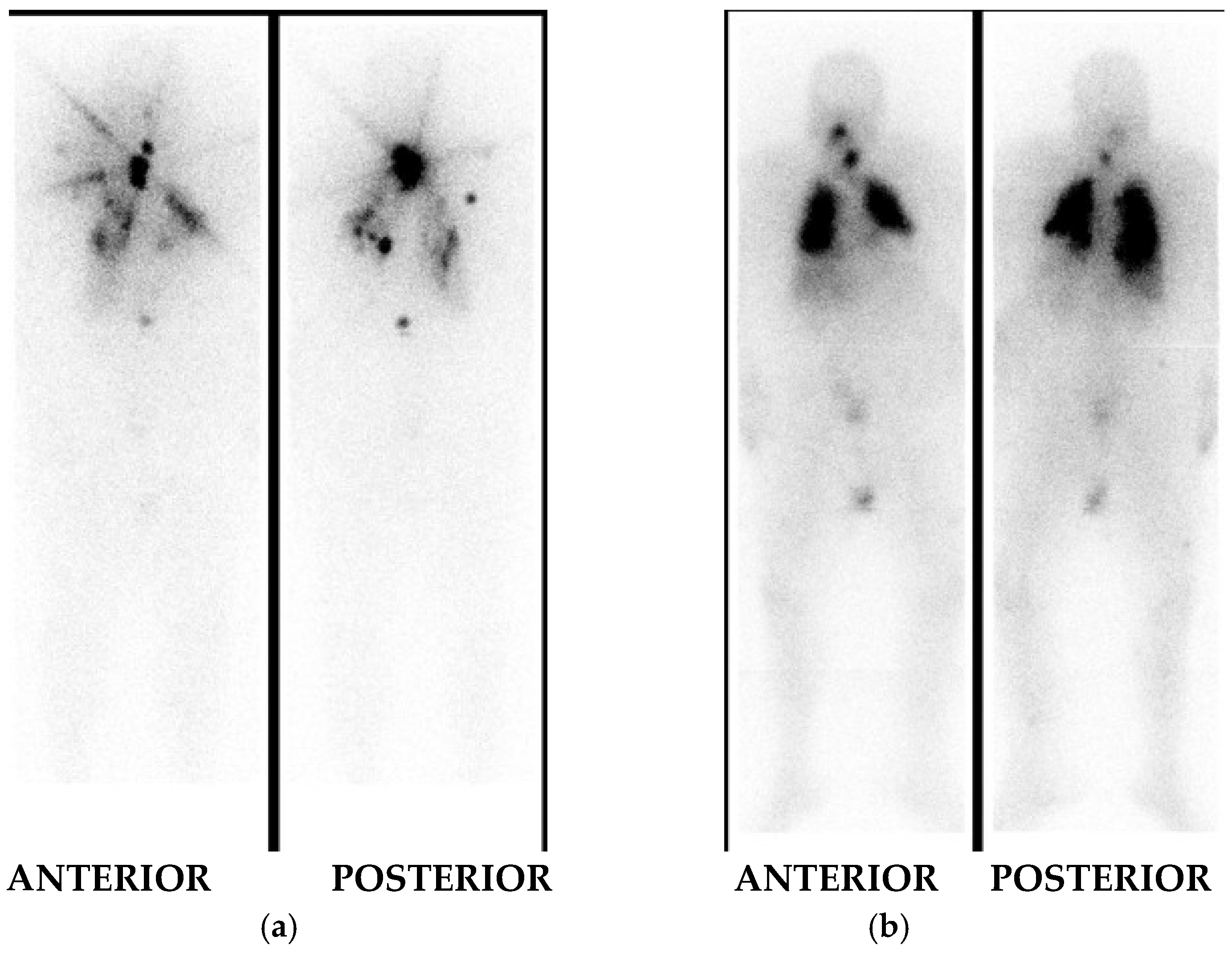 Evolving Paradigm in Radioactive Iodine Therapy for