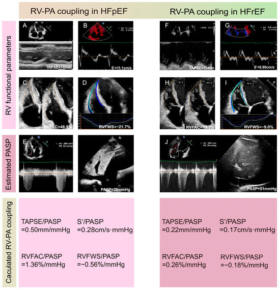 Clinical Usefulness of Right Ventricular–Pulmonary Artery Coupling in ...