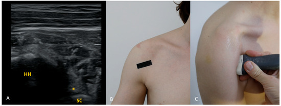 Clock-Face Sonography of the Glenoid Labrum: A Pictorial Technical ...