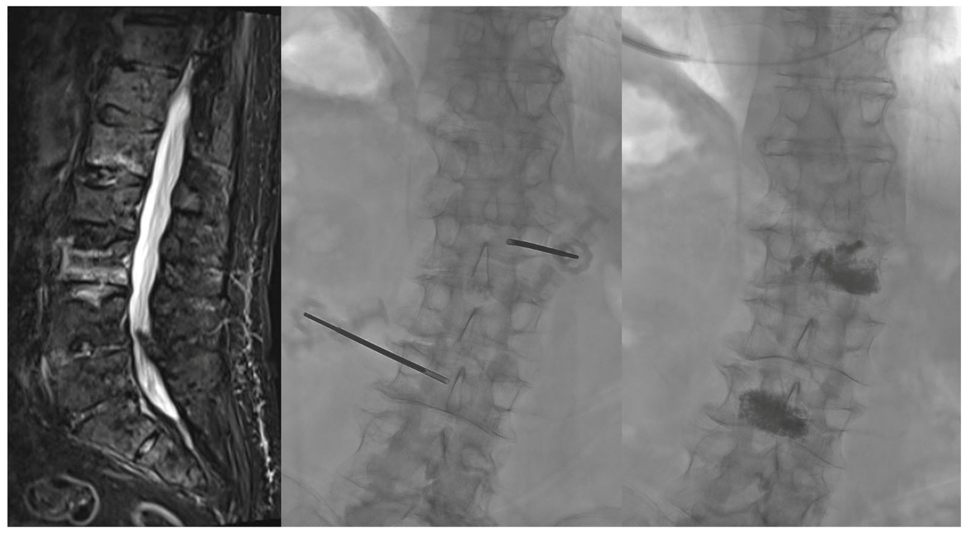 Subacute and Chronic Low-Back Pain: From MRI Phenotype to Imaging