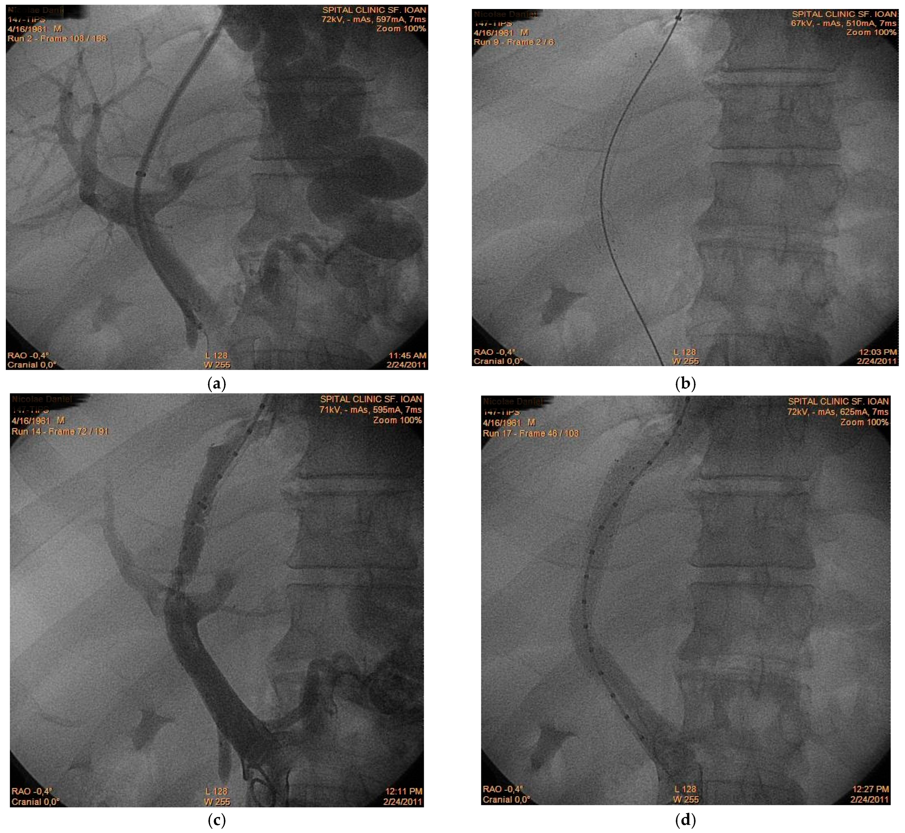Rare Causes of Portal Vein Thrombosis and Occlusion: A Narrative Review