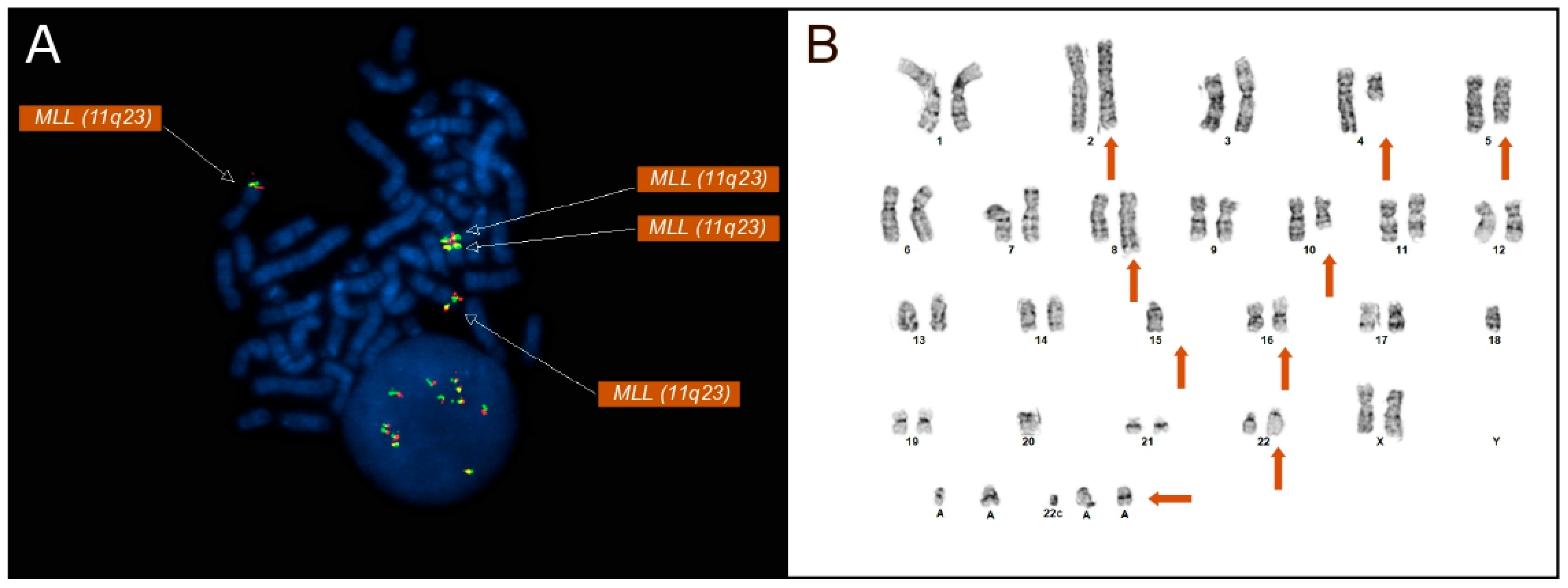 A Rare Case of De Novo Acute Myeloid Leukemia, Featuring a KMT2A (MLL ...