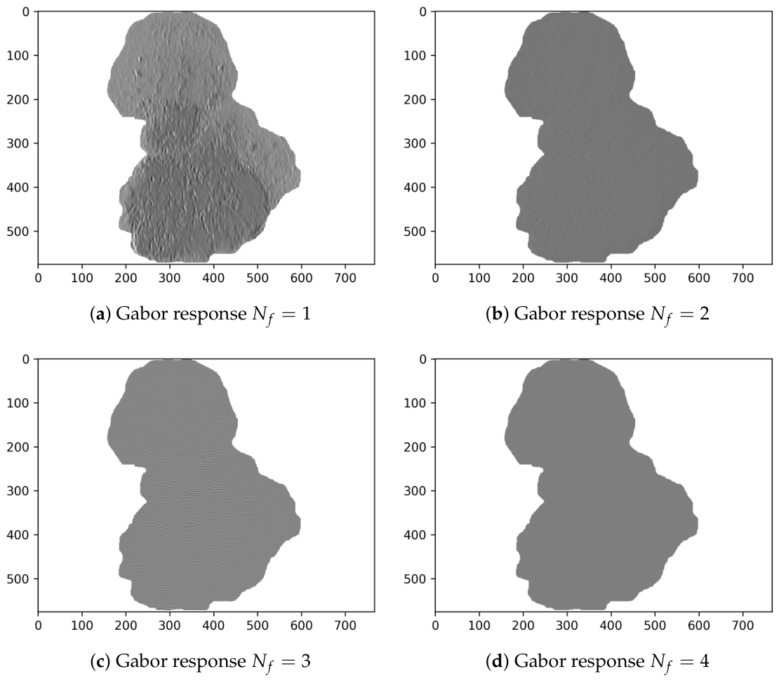 Evolutionarily Optimized Multi-Scale Gabor Modeling of Directional Lesion Texture in Dermoscopic Images for Interpretable Melanoma Classification