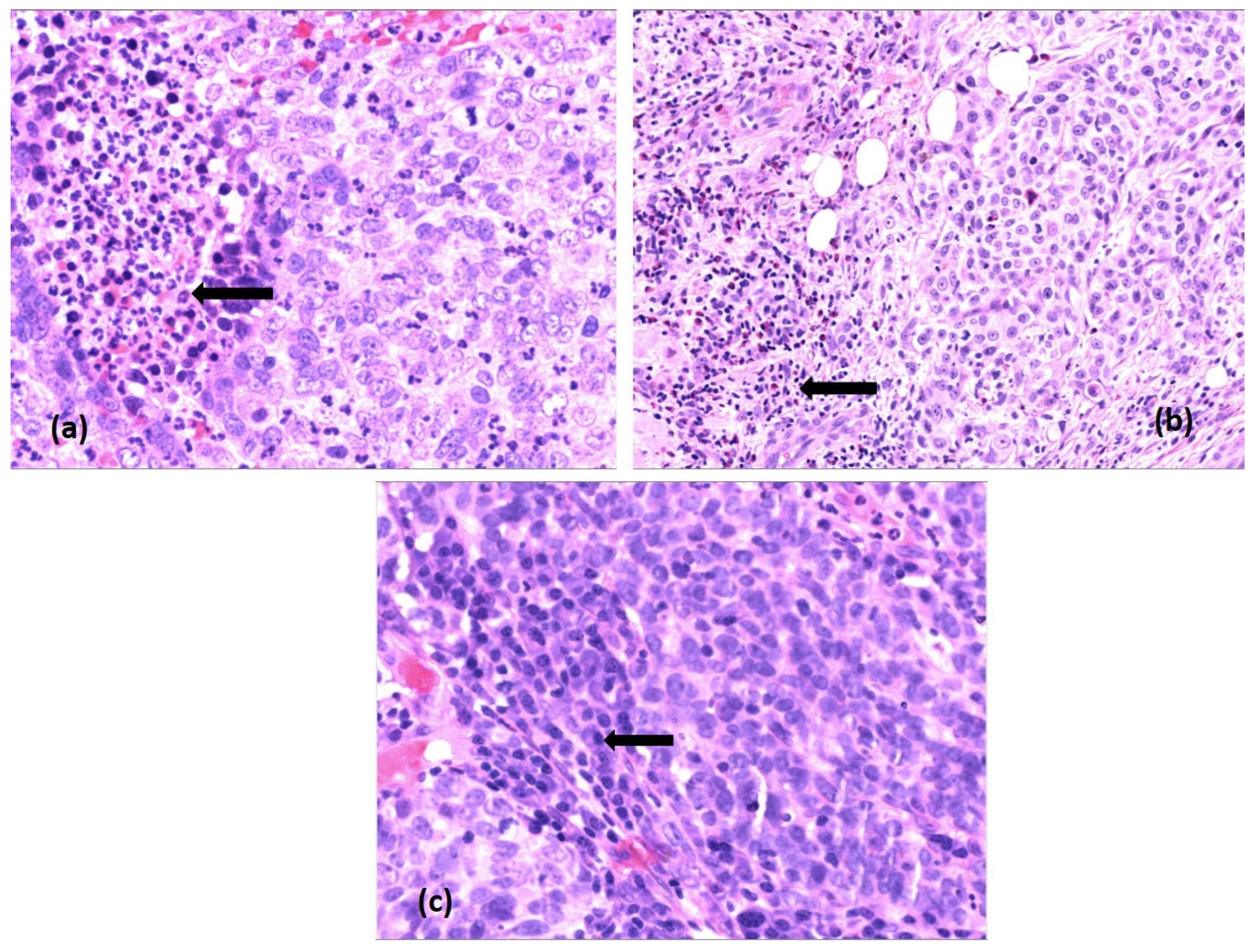 Immunohistochemical Study of the Tumor Immune Microenvironment in Laryngeal Squamous Cell Carcinoma and Its Prognostic Implications