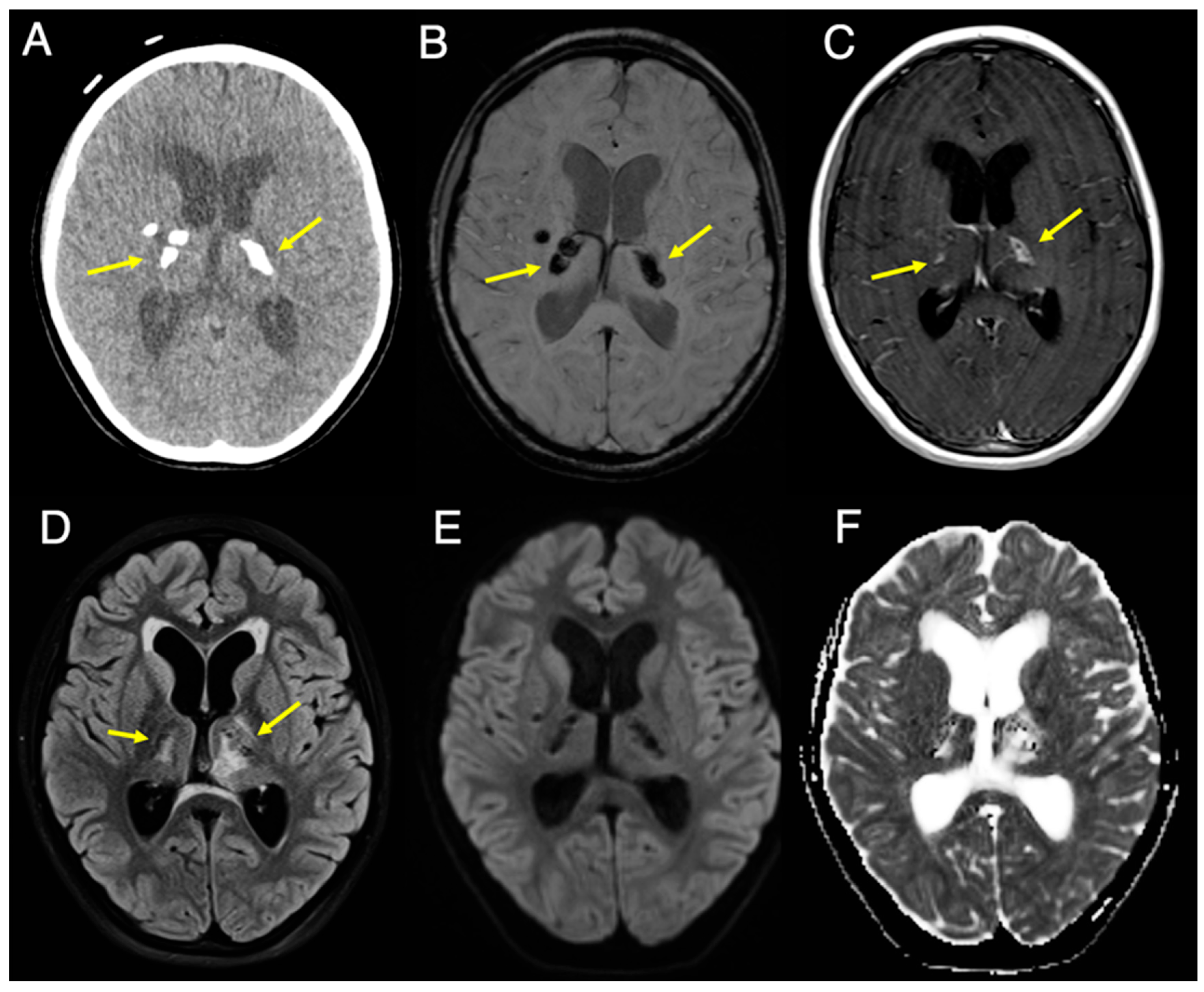 Cerebroretinal Microangiopathy with Calcifications and Cysts (CRMCC): A 5-Year Diagnostic Challenge