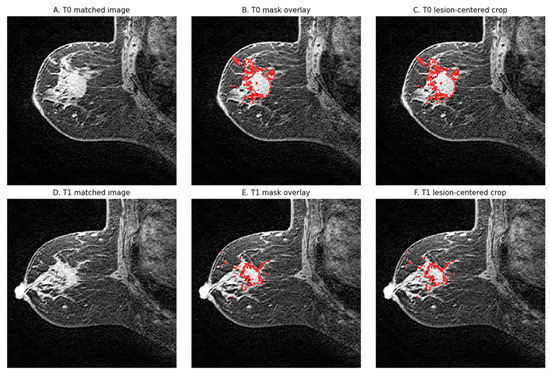 Longitudinal Breast MRI for Early Treatment-Response Modeling: A