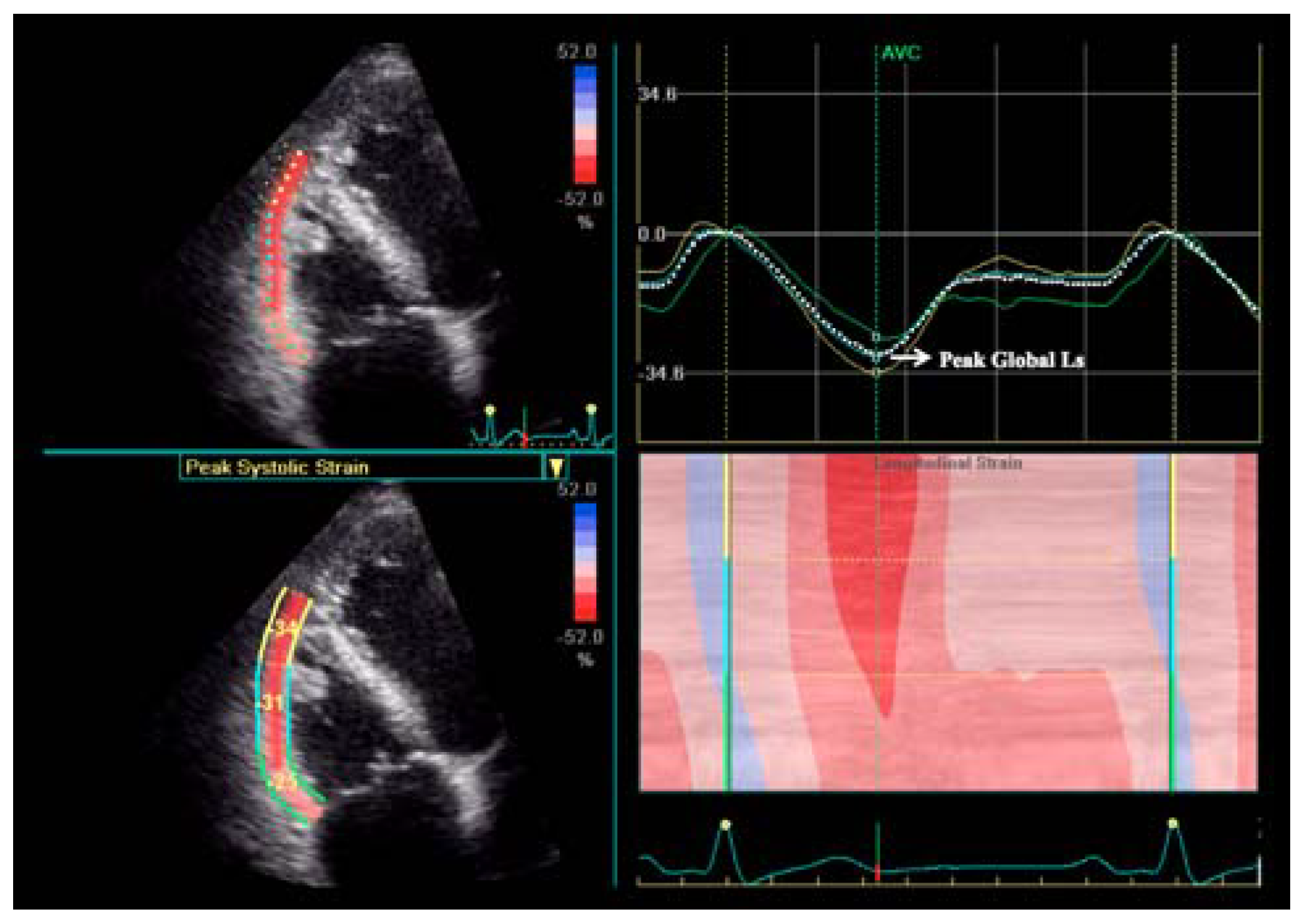 Diseases Free FullText Right Ventricular Geometry and Function in