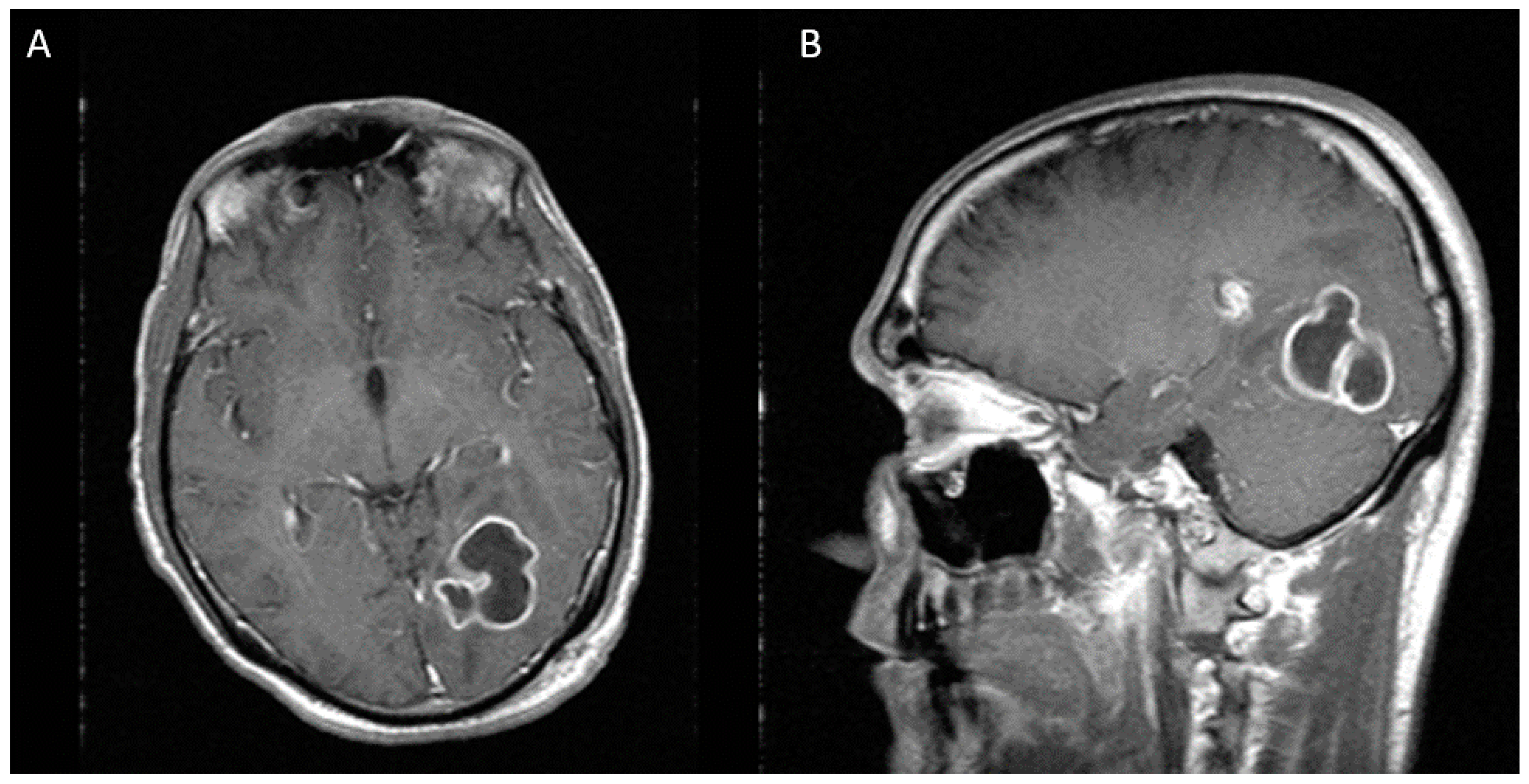 Diseases Free FullText Pyogenic Brain Abscess Caused by Peptostreptococcus in a Patient