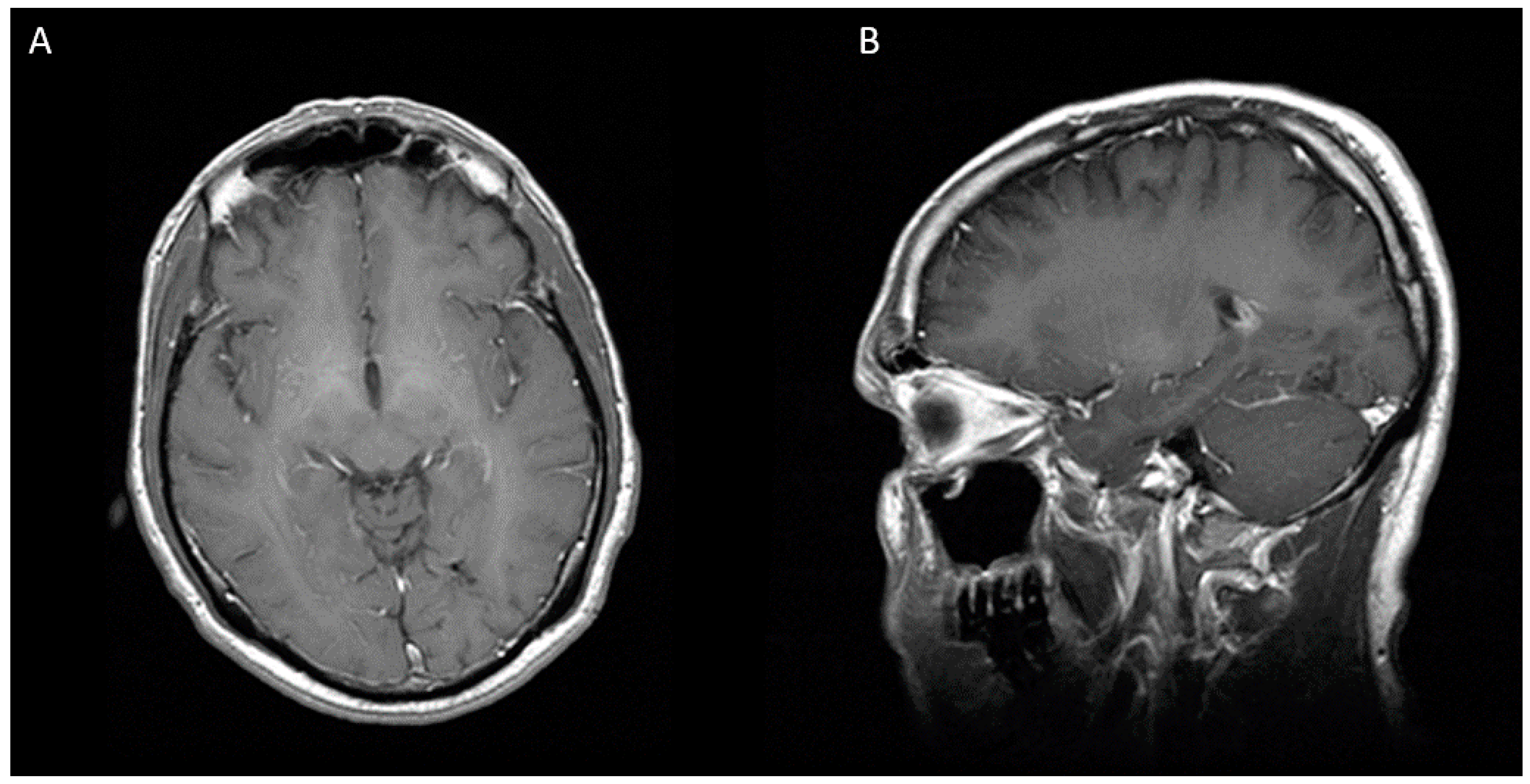 Diseases Free FullText Pyogenic Brain Abscess Caused by Peptostreptococcus in a Patient