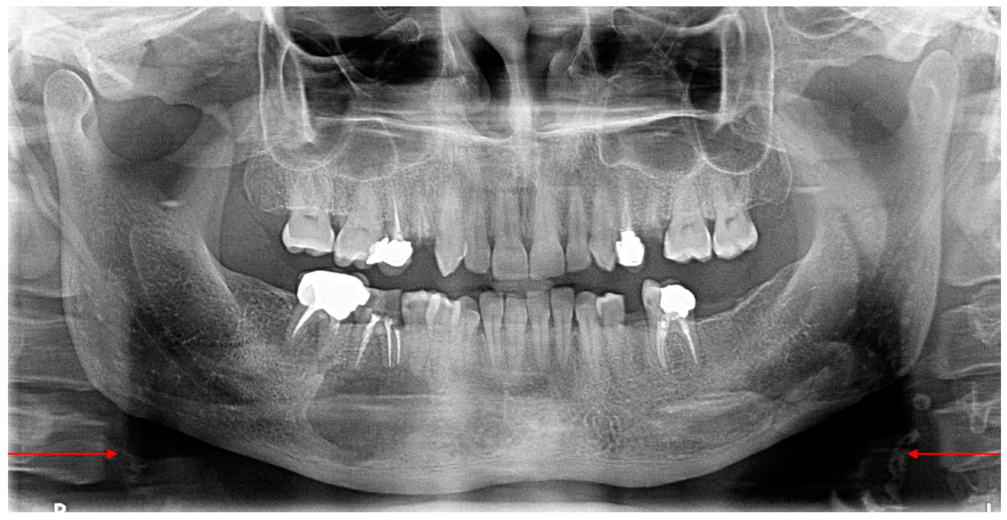 noncompressible calcified vessel meaning noncompressible calcified vessel meaning