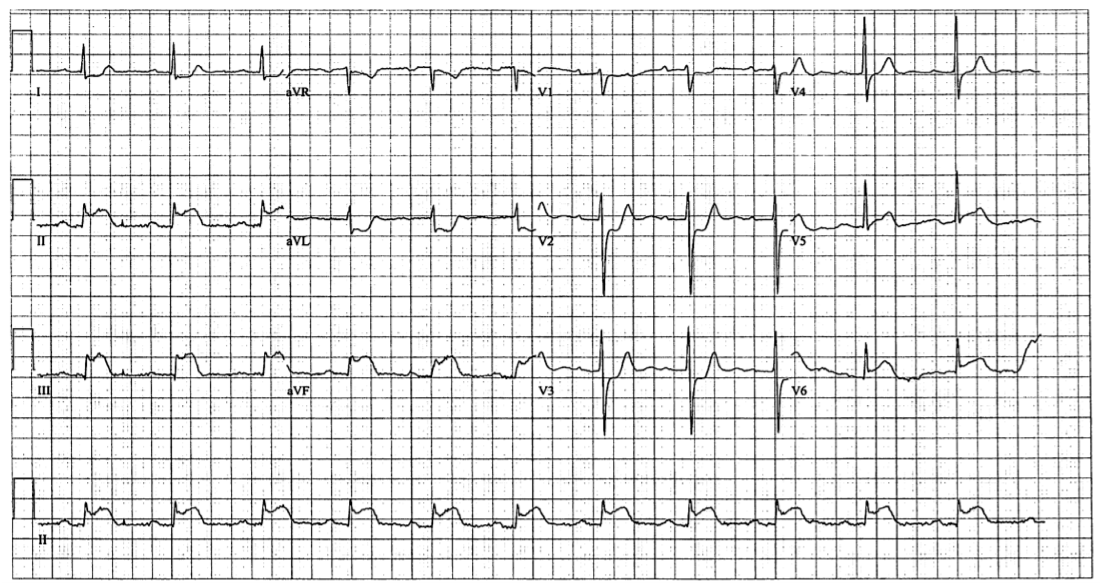 diseases free full text st elevation myocardial infarction in st elevation myocardial infarction