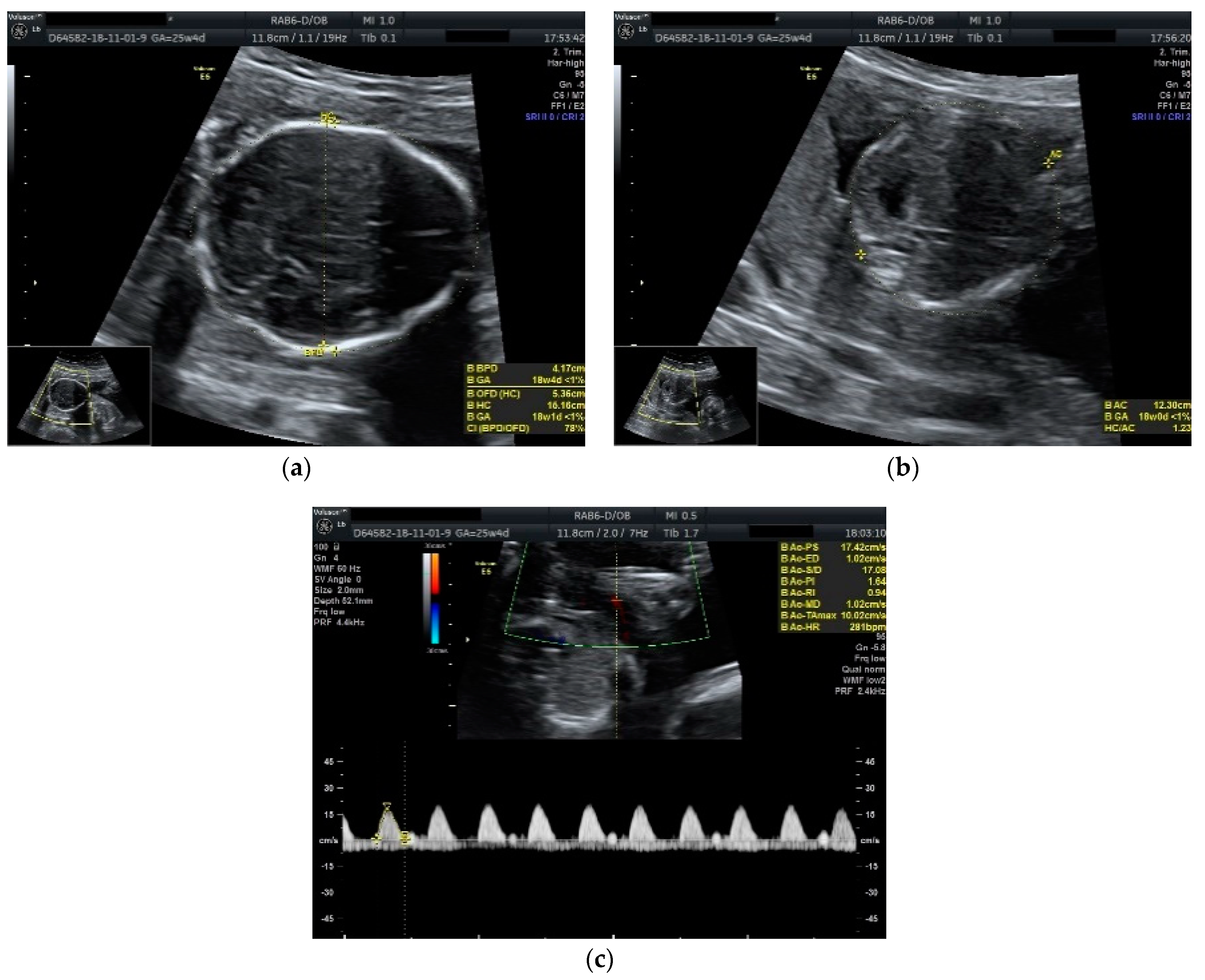 Diseases Free Full Text Single Fetal Demise In Twin Pregnancy A Great Concern But Still A Favorable Outcome Html