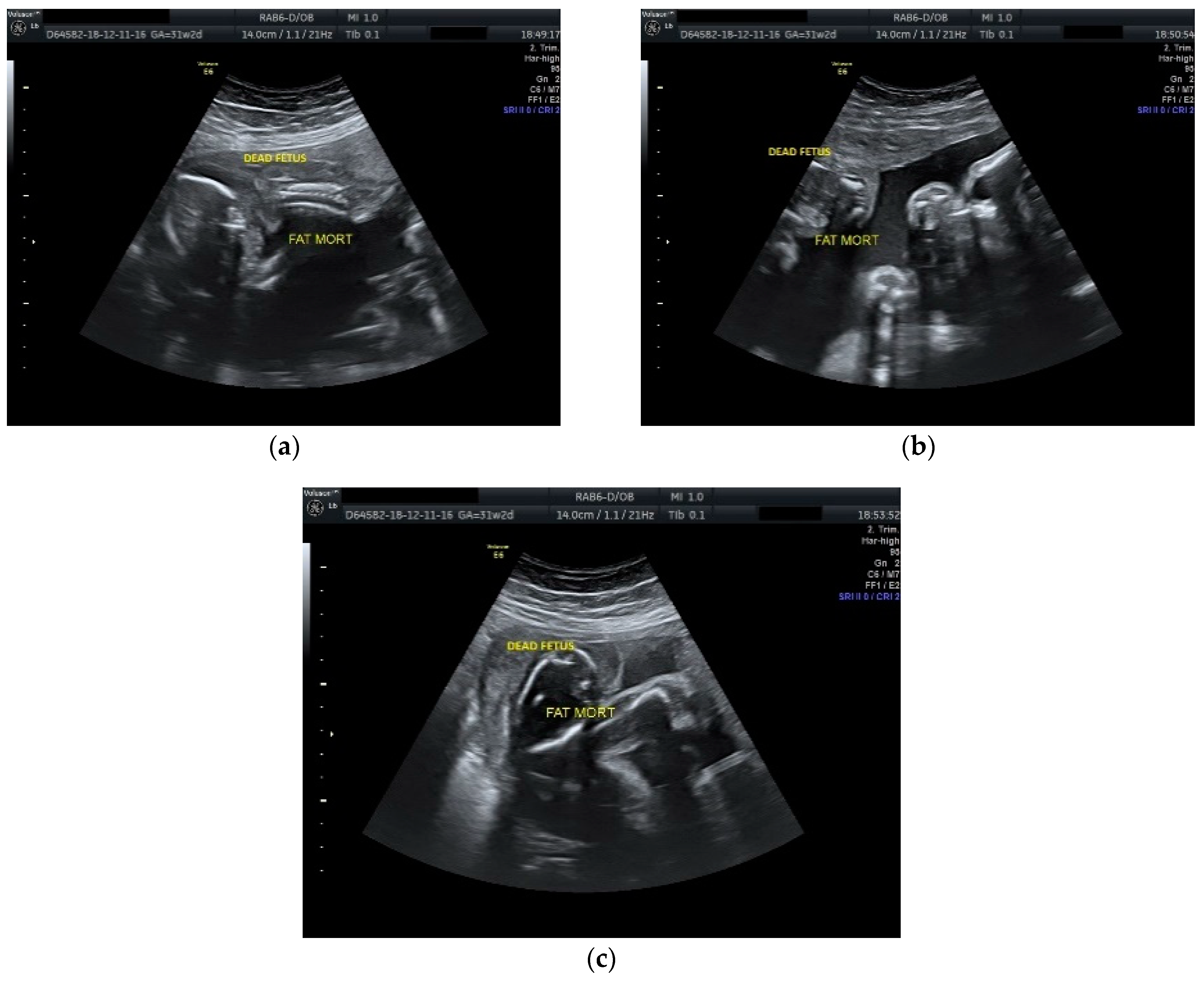 Yrew/Hidden Twin Ultrasound Pictures.Html - 6ossjic