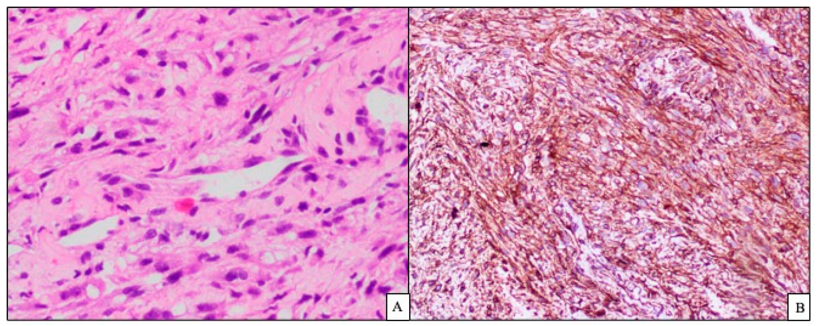 A Primary Mediastinal Monophasic SpindleCell Synovial with