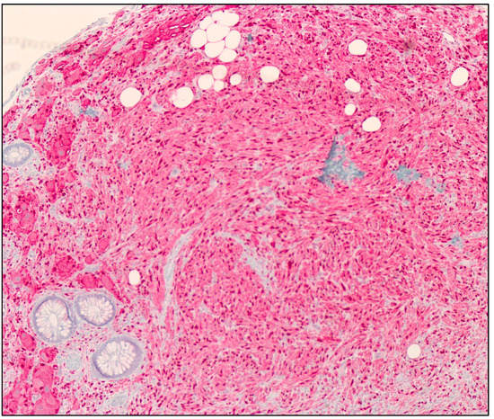 Ganglioneuroma Colon
