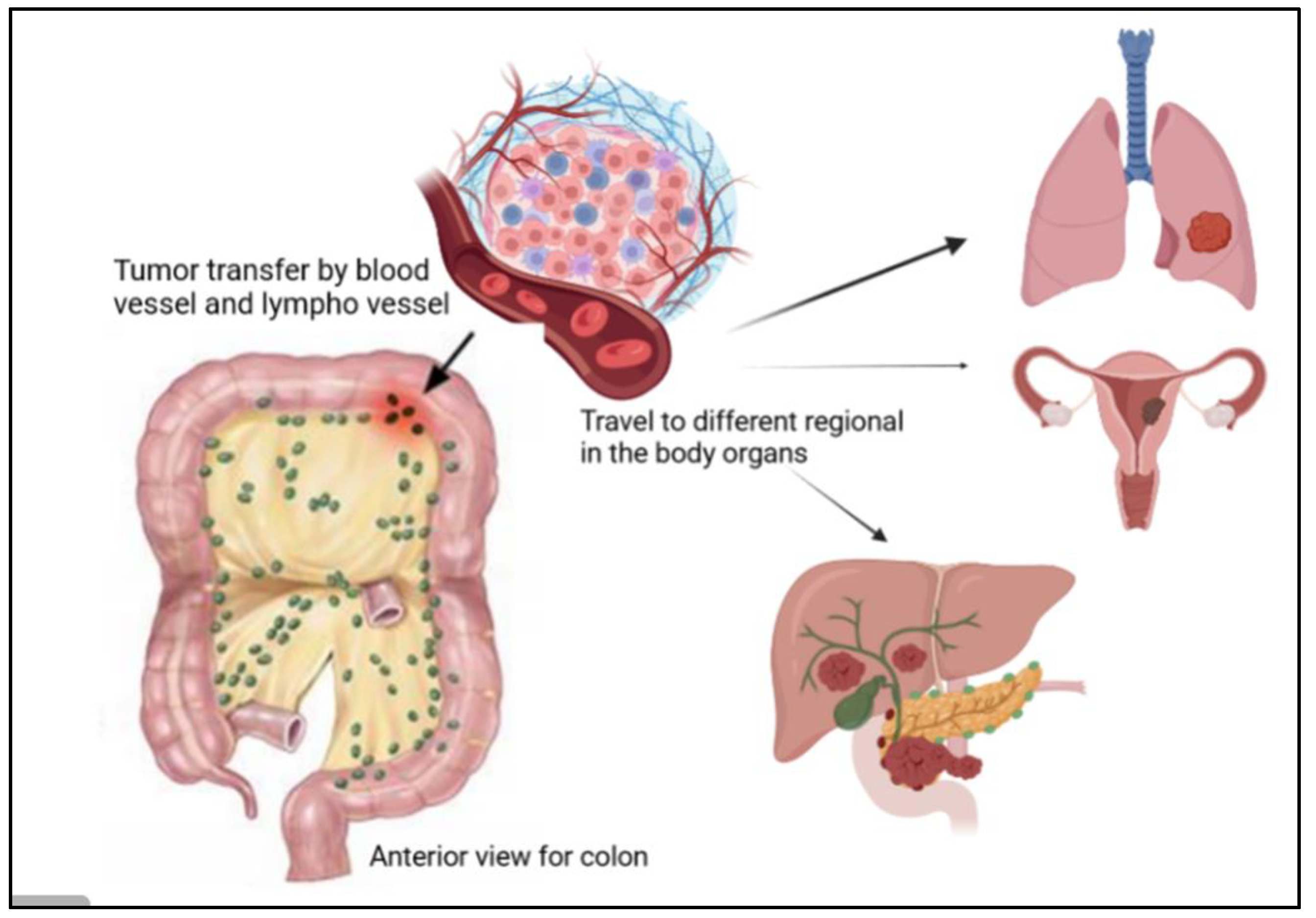 diseases-free-full-text-progress-and-perspectives-in-colon-cancer