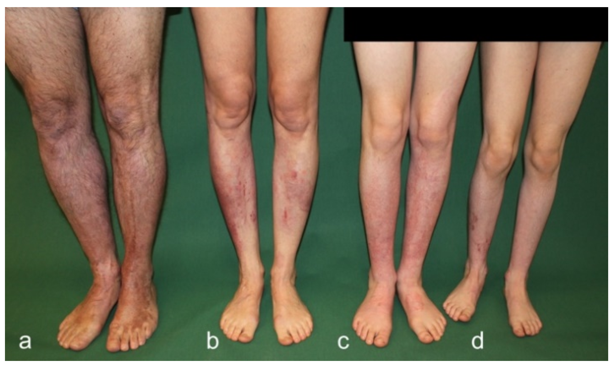 difference between 1st degree burn and 2nd