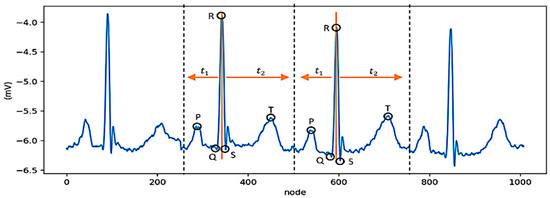Deep Learning-Based Stacked Denoising and Autoencoder for ECG Heartbeat ...