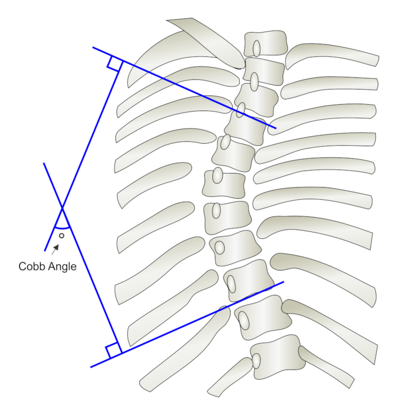 Figure 2.Cobb angle. 