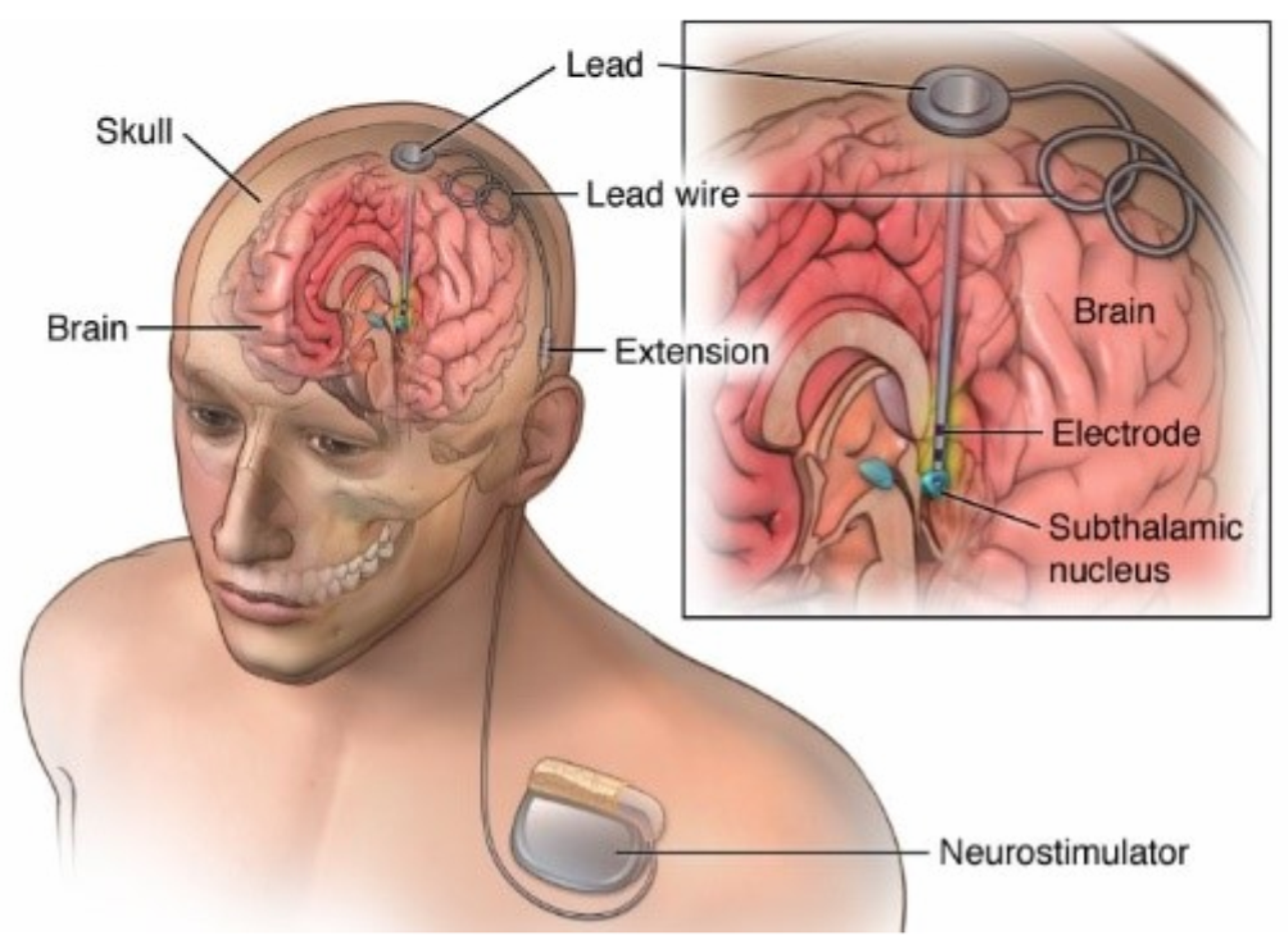 Deep brain. Электроды в головной мозг. Глубокая стимуляция мозга.