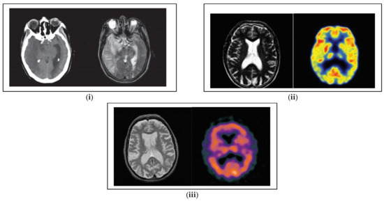 Artificial Intelligence-Based Multimodal Medical Image Fusion Using ...