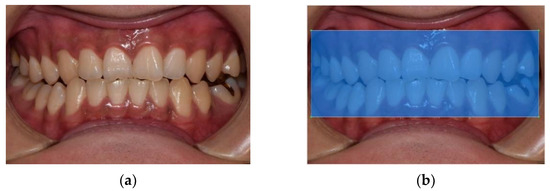 Periodontal Disease Classification with Color Teeth Images Using ...