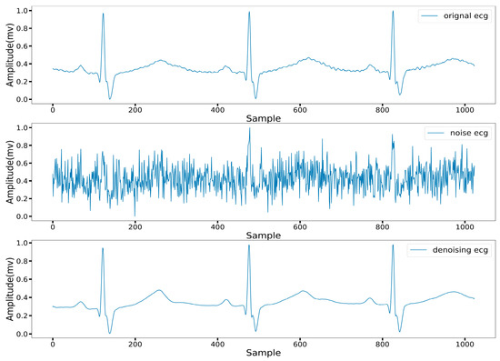 ECG Signal Denoising Method Based on Disentangled Autoencoder