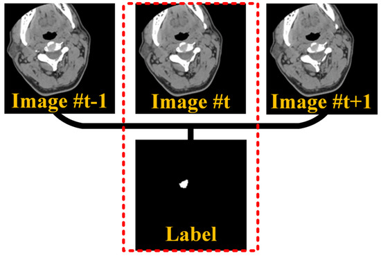 Cervical Intervertebral Disc Segmentation Based on Multi-Scale ...