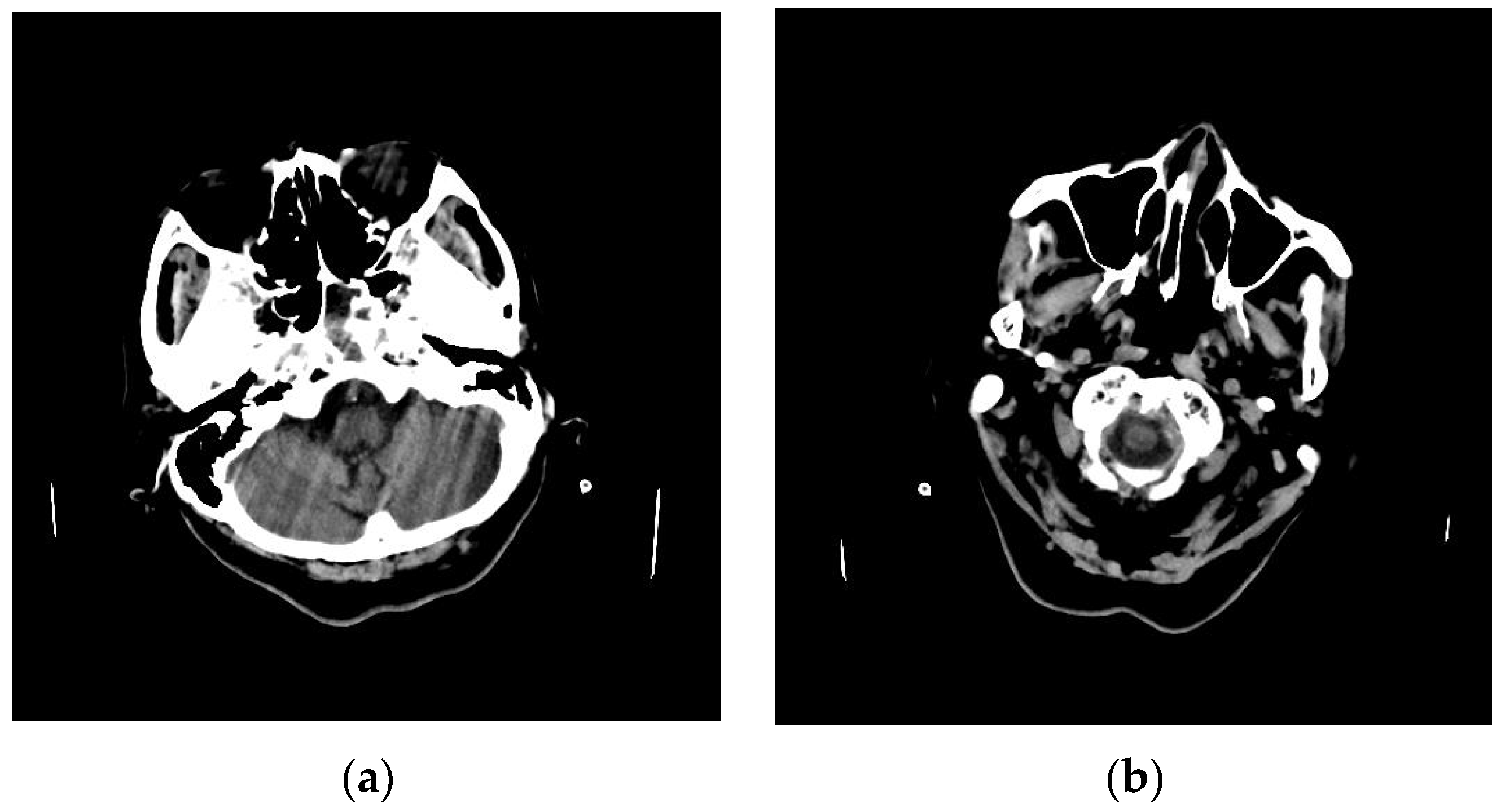 Electronics Free FullText Motion Artifact Detection Based on