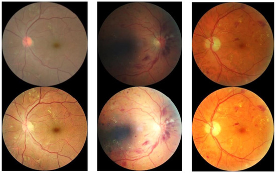 Fundus Image Generation and Classification of Diabetic Retinopathy ...