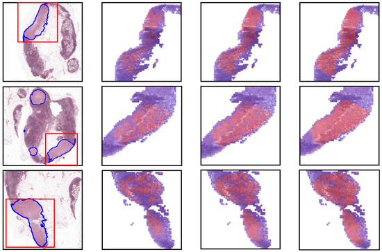 Dual-Attention Multiple Instance Learning Framework for Pathology Whole ...