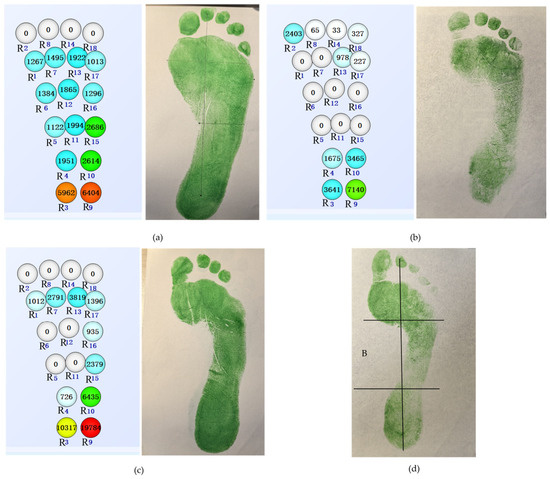 Research on Plantar Signal Measurement and Foot Arch Classification