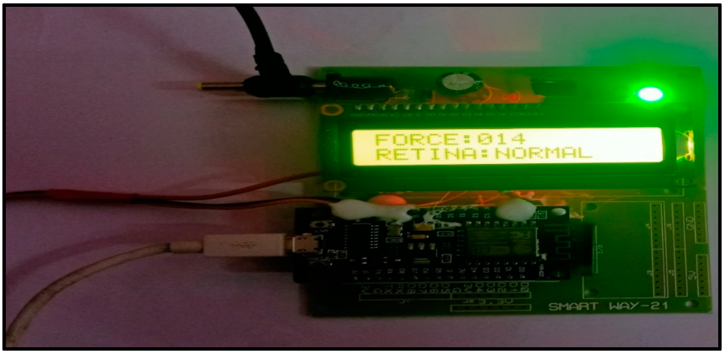 Engineering Proceedings | Free Full-Text | Intraocular Pressure ...