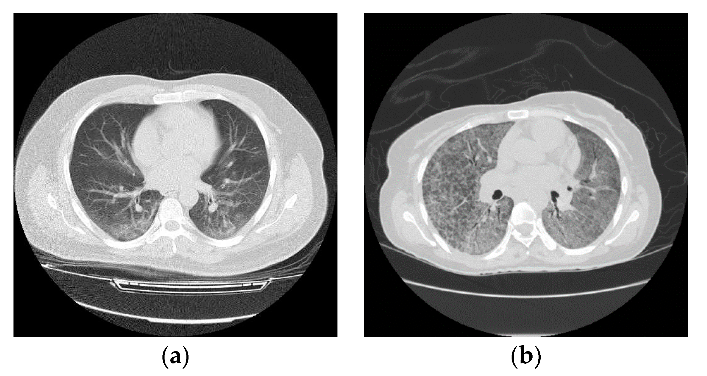 Entropy Free Full Text Classification Of Covid 19 Coronavirus Pneumonia And Healthy Lungs In Ct Scans Using Q Deformed Entropy And Deep Learning Features Html