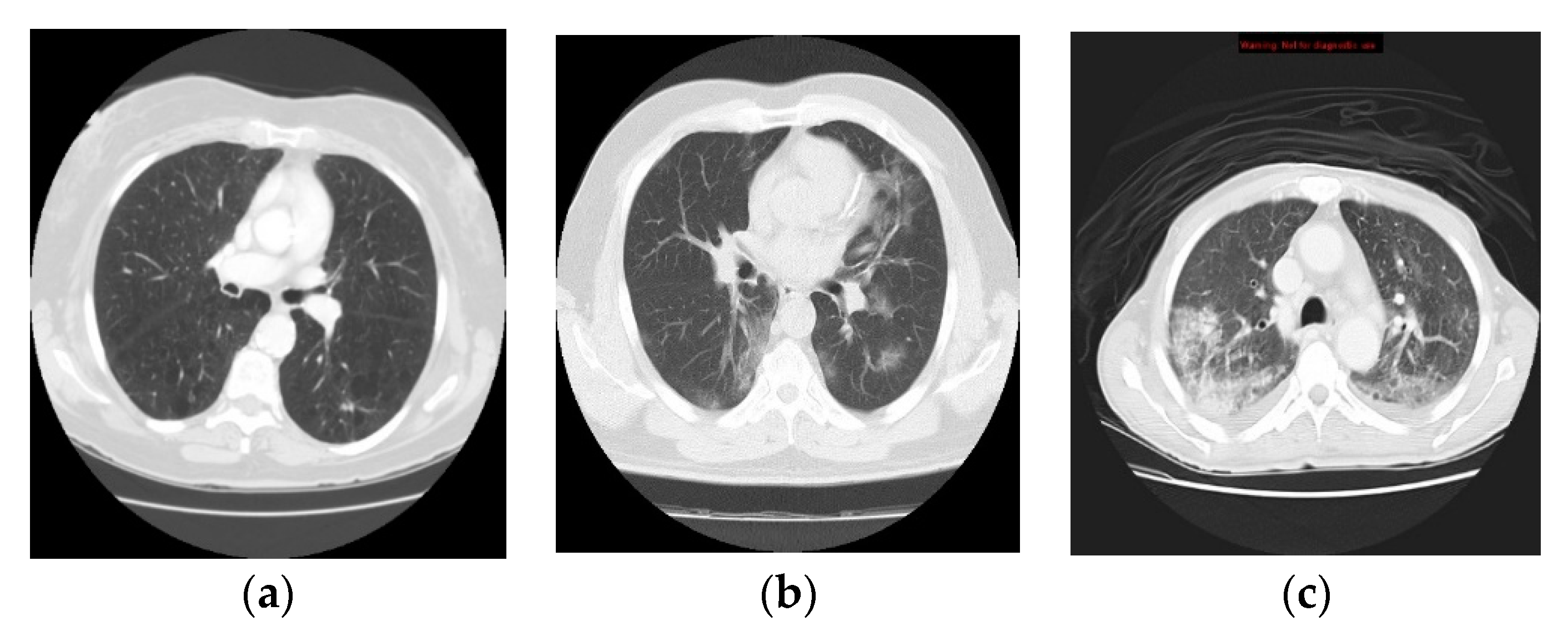 mesothelioma pleural cavity