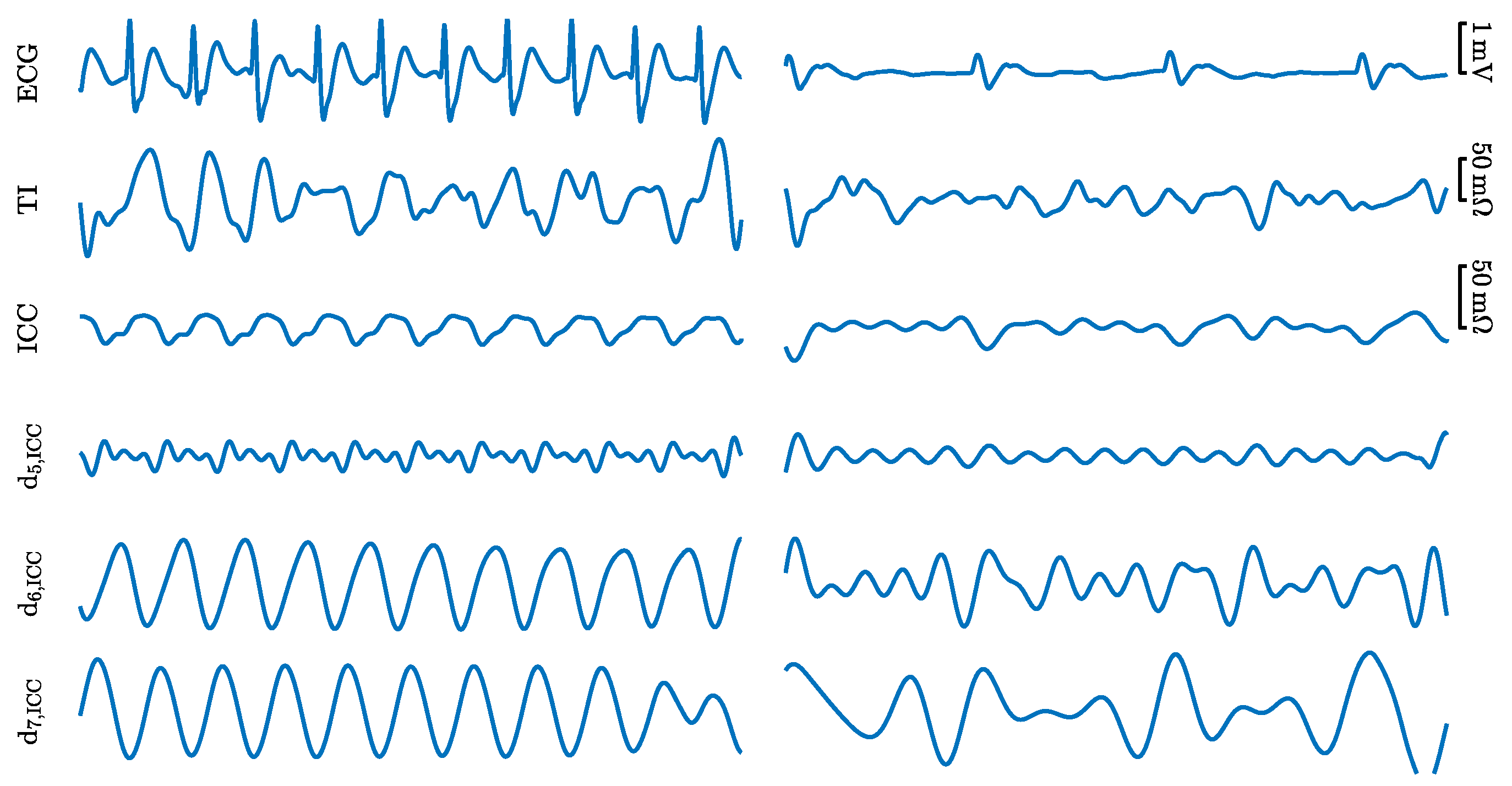 Pulseless electrical activity ecg