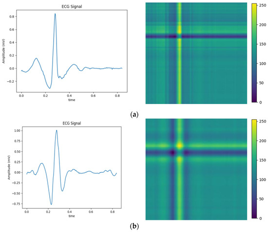 Deep Learning Modeling of Cardiac Arrhythmia Classification Deep Learning Modeling of Cardiac Arrhythmia Classification